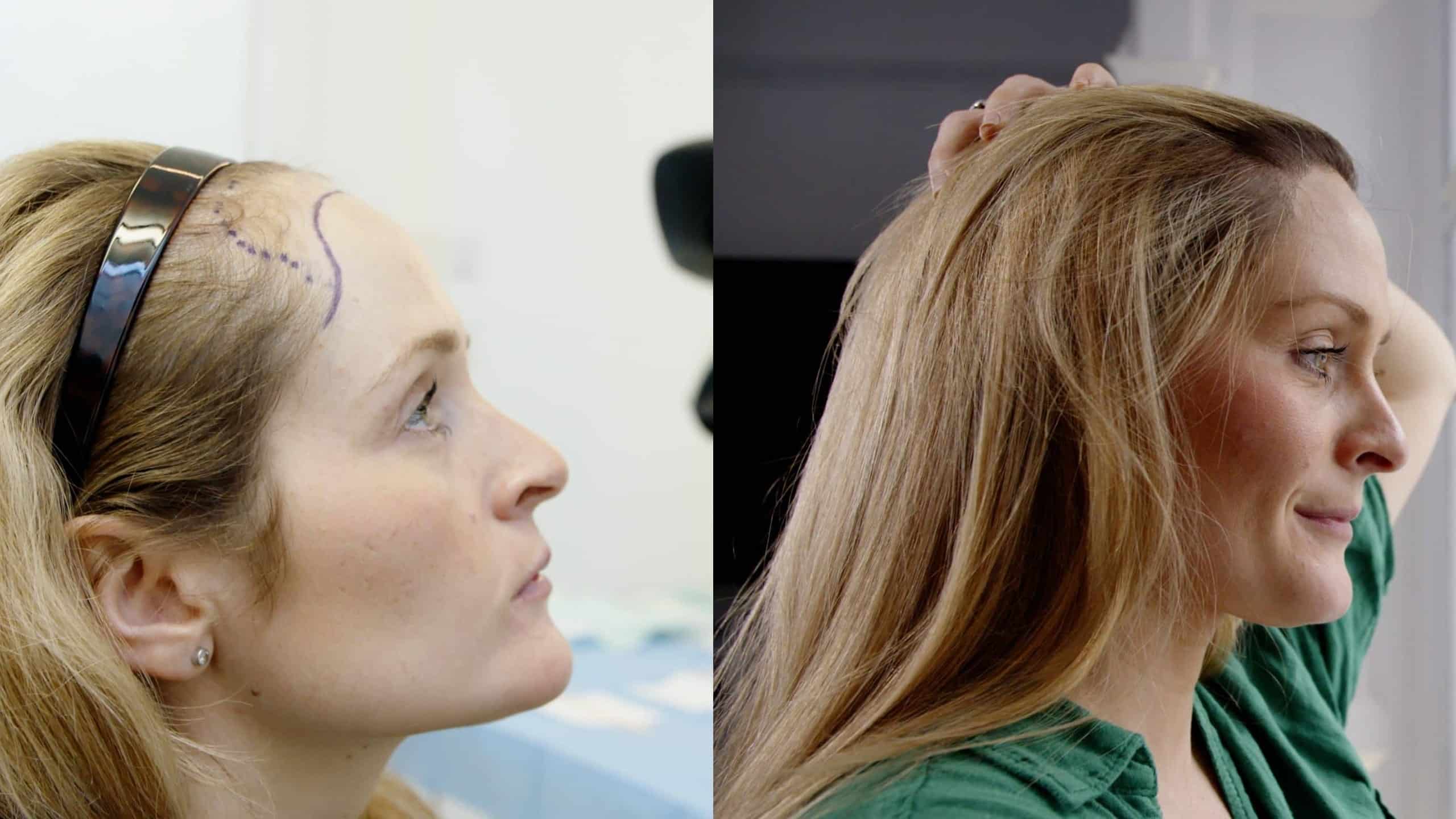 Hair Transplant UK – Restore Receding Hairlines